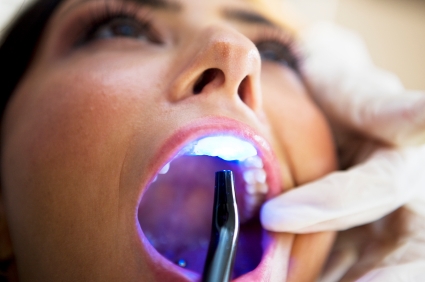 Lazerle Diş Çürüğü Nasıl Tedavi Edilir